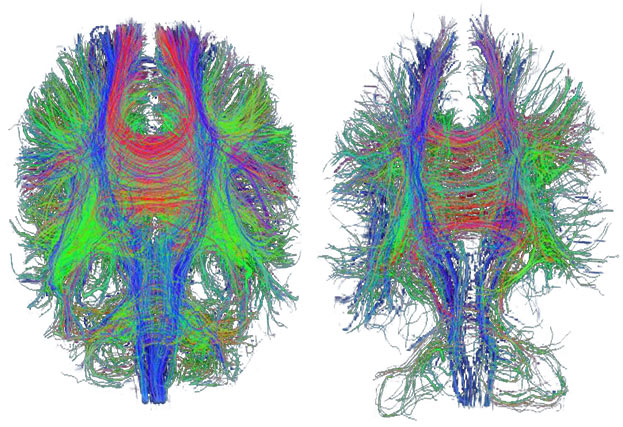 DTI-nerves